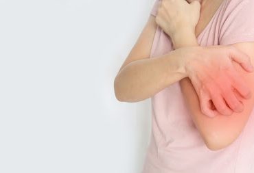 what does scabies look like